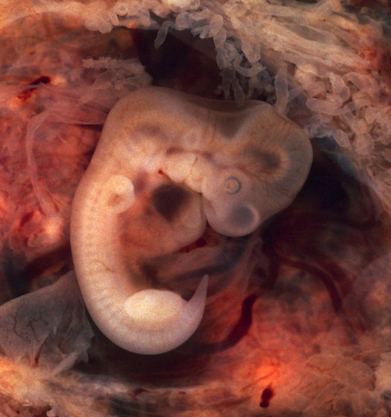 562px-Tubal_Pregnancy_with_embryo